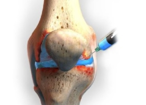nexs medical xin wang knee lubrication injection